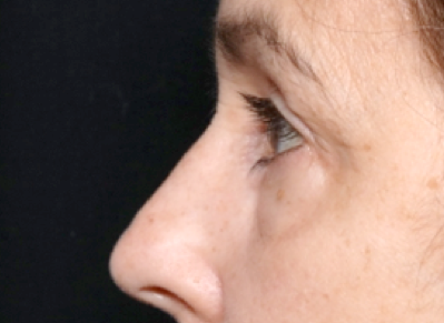 Blepharoplasty Before & After Patient #31075