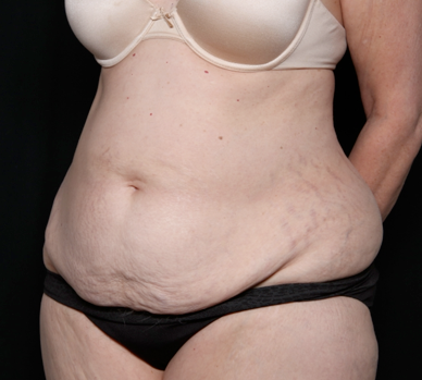 Tummy Tuck Before & After Patient #31118