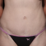 Tummy Tuck Before & After Patient #31063