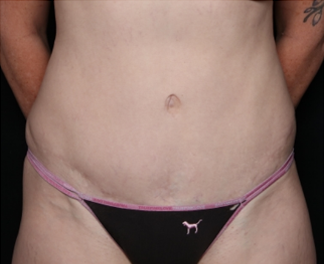 Tummy Tuck Before & After Patient #31063