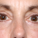 Blepharoplasty Before & After Patient #31075