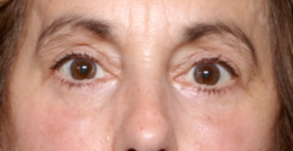 Blepharoplasty Before & After Patient #31075