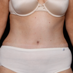 Tummy Tuck Before & After Patient #31118