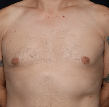 Gynecomastia Before & After Patient #31146