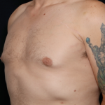 Gynecomastia Before & After Patient #31146