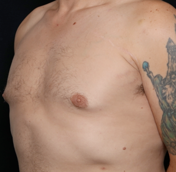 Gynecomastia Before & After Patient #31146