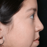 Rhinoplasty Before & After Patient #31050