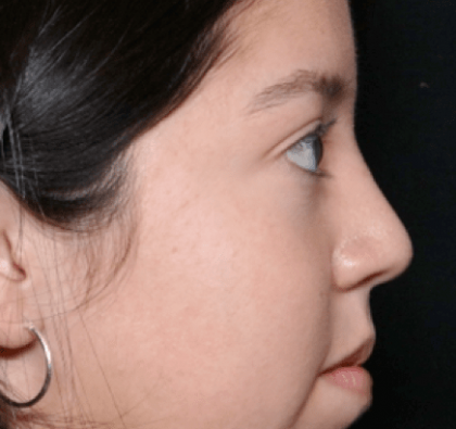 Rhinoplasty Before & After Patient #31050