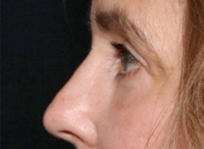 Blepharoplasty Before & After Patient #31075