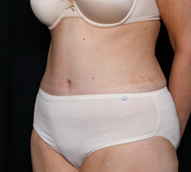 Tummy Tuck Before & After Patient #31118