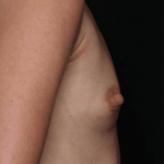 Breast Augmentation Before & After Patient #31038