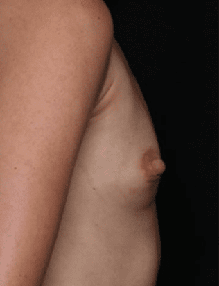 Breast Augmentation Before & After Patient #31038