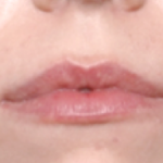 Lip Filler Before & After Patient #31027