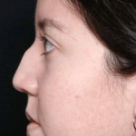 Rhinoplasty Before & After Patient #31050