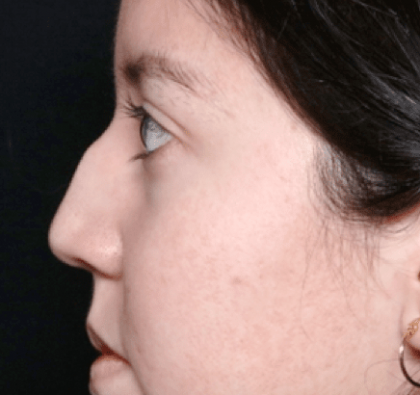 Rhinoplasty Before & After Patient #31050