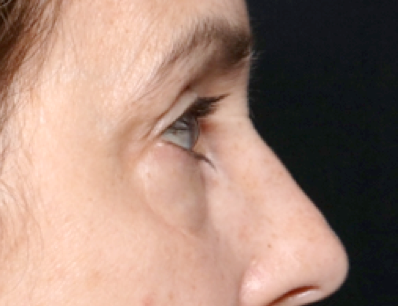 Blepharoplasty Before & After Patient #31075