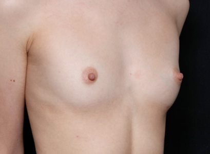 Breast Augmentation - Saline Implants Before & After Patient #31129