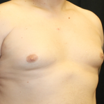 Gynecomastia Before & After Patient #31146