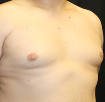 Gynecomastia Before & After Patient #31146