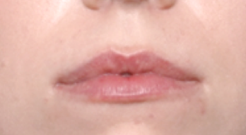 Lip Filler Before & After Patient #31027