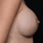 Breast Augmentation Before & After Patient #31038