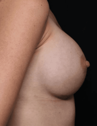 Breast Augmentation Before & After Patient #31038