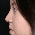 Rhinoplasty Before & After Patient #31050