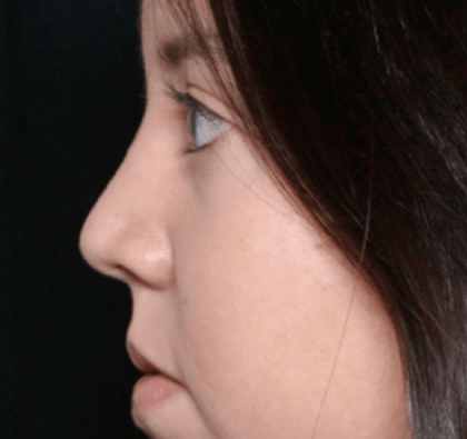 Rhinoplasty Before & After Patient #31050