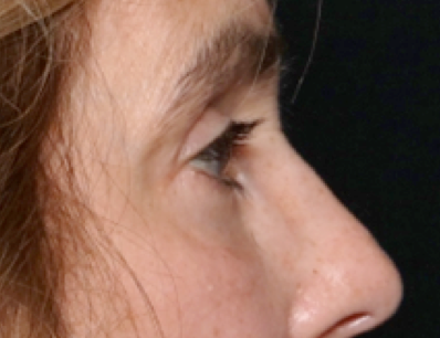 Blepharoplasty Before & After Patient #31075