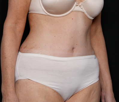 Tummy Tuck Before & After Patient #31118