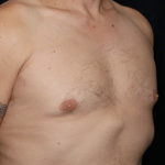 Gynecomastia Before & After Patient #31146