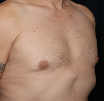 Gynecomastia Before & After Patient #31146