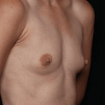 Breast Augmentation Before & After Patient #31038