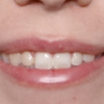 Lip Filler Before & After Patient #31027