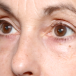 Blepharoplasty Before & After Patient #31075