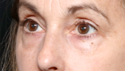 Blepharoplasty Before & After Patient #31075