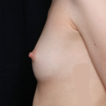 Breast Augmentation - Saline Implants Before & After Patient #31129