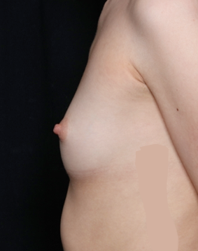 Breast Augmentation - Saline Implants Before & After Patient #31129