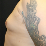 Gynecomastia Before & After Patient #31146