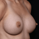 Breast Augmentation Before & After Patient #31038