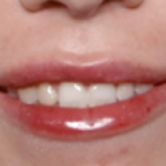 Lip Filler Before & After Patient #31027