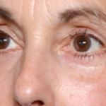 Blepharoplasty Before & After Patient #31075