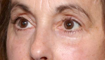 Blepharoplasty Before & After Patient #31075