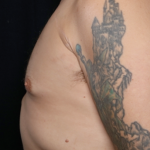Gynecomastia Before & After Patient #31146