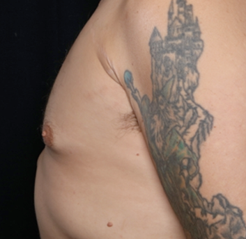 Gynecomastia Before & After Patient #31146