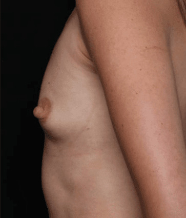 Breast Augmentation Before & After Patient #31038