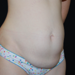 Tummy Tuck Before & After Patient #31063