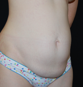 Tummy Tuck Before & After Patient #31063