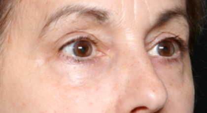 Blepharoplasty Before & After Patient #31075