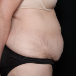 Tummy Tuck Before & After Patient #31118